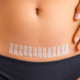 Addome di una donna adulta con una cicatrice chirurgica orizzontale coperta da strisce adesive medicali.