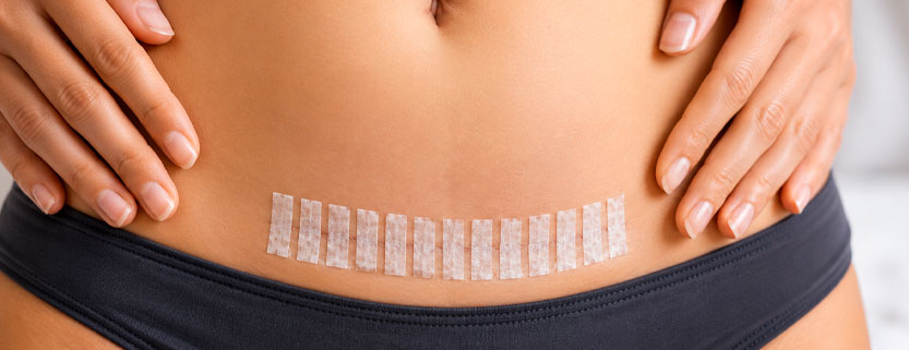 Addome di una donna adulta con una cicatrice chirurgica orizzontale coperta da strisce adesive medicali.